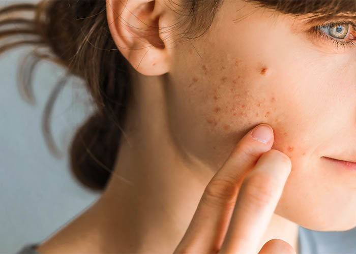 Skin Concern Acnes Truth Treatment Systems