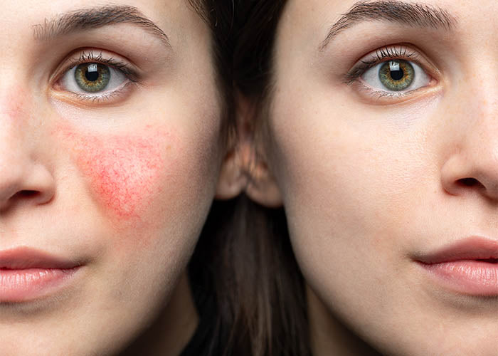 ROSACEA SKIN HEALTH SYSTEM